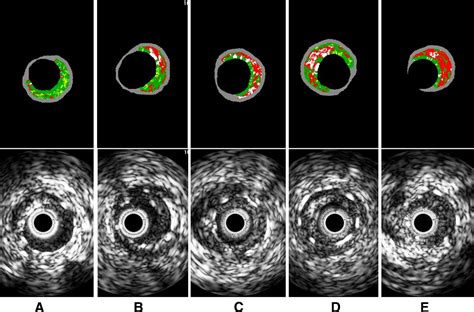 Tissue Characterization Of In Stent Neointima Using Intravascular