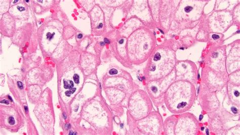 Pathology Outlines Chromophobe