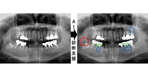 業界初『歯科パノラマエックス線画像のai診断支援システムを用いた外来診療』開始のお知らせ 医療法人社団 葵会 Aoi国際病院のプレスリリース