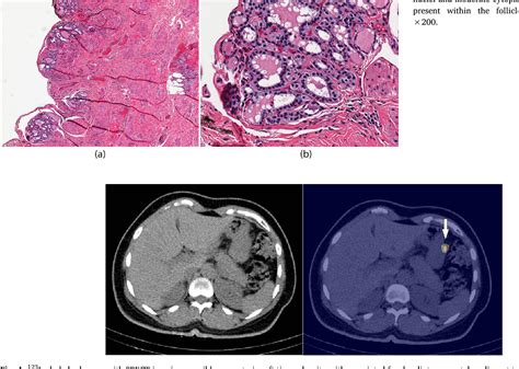 Figure 3 From Management Of Highly Differentiated Thyroid Follicular