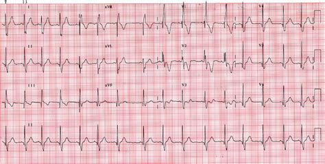 Ejemplos De Ekg