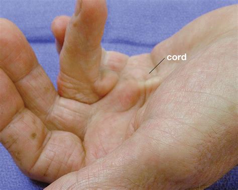 Dupuytren Contracture Pictures - Dupuytren Contracture Institute