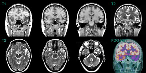 Semantic dementia - NEURORADIOLOGY