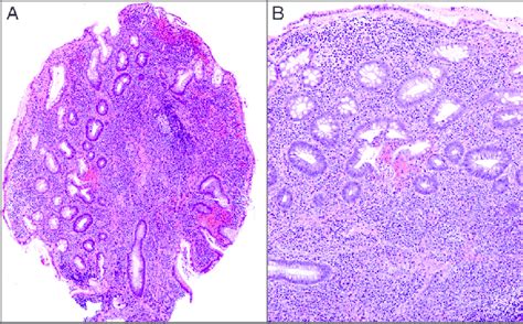 Hematoxylin And Eosin Staining Of Sigmoid Mass Biopsy Showing