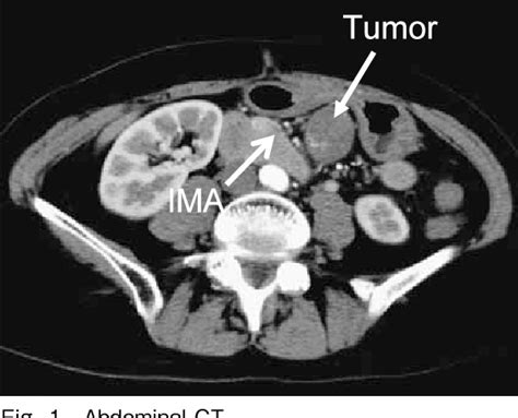 Figure From A Case Of Laparoscopic Gastrectomy For Gastric Cancer And