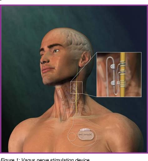 Figure From Vagus Nerve Stimulation Semantic Scholar