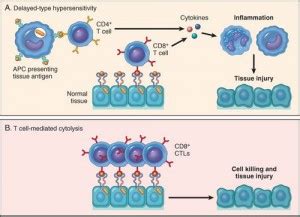 Type 4 hypersensitivity – Medchrome