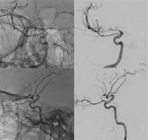 Intracranial Arterial Dissection | neuroangio.org