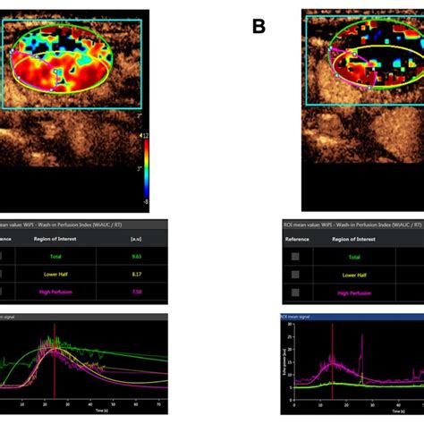 Contrast Enhanced Ultrasound Ceus Imaging Series Of A Lymphnode