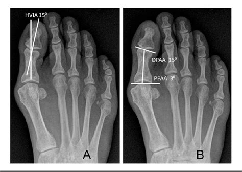 Correction Of Hallux Valgus Interphalangeus With An Osteotomy Of The