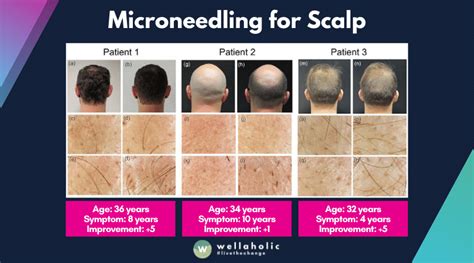 How Often Microneedling For Hair Loss