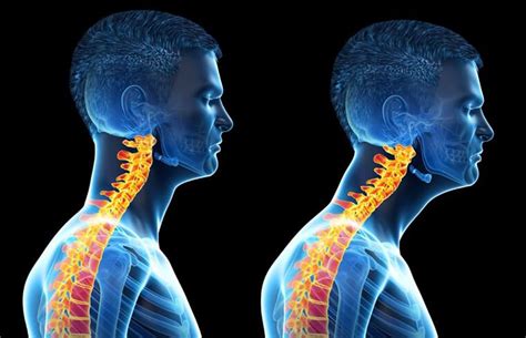 3 Way To Fix Forward Head Posture Best Way To Get Rid Of Forward Head