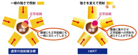 強度変調放射線治療imrt強度変調回転照射vmat 放射線治療科 専門診療科・その他の診療科 診療科・部門 地方独立