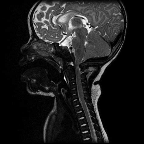 Achondroplasia - wikidoc