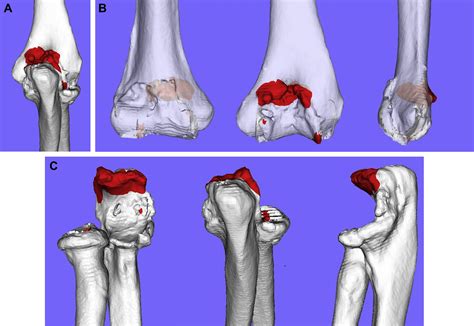 Utility Of A Dimensionally Printed Color Coded Bone Model To