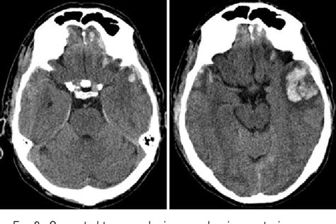 Brain Contusion | Semantic Scholar