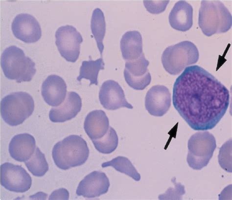 EXAM 3 Hematology Quiz And Labs Flashcards Quizlet