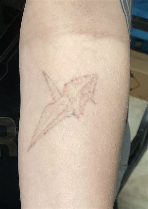 how many sessions of laser tattoo removal 7