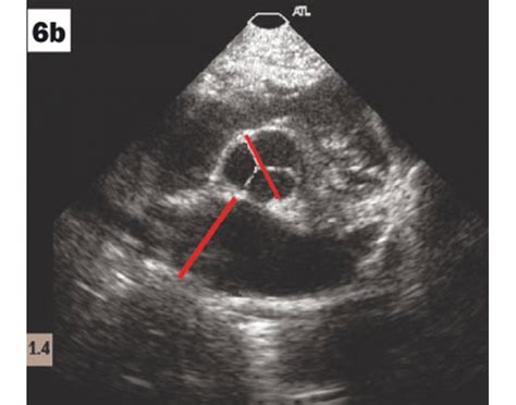 parasternal short axis view ao level echo quiz