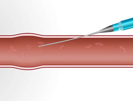 Arterial Line Placement: Over-the-Wire and Over-the-Needle | Emergency ...