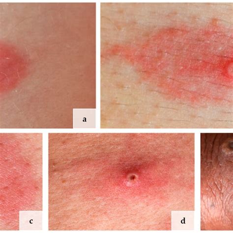 Lives Of Lesions In Mpox In Different Patients A Macular Stage