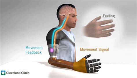 Las Pr Tesis De Brazo Basadas En Interfaces Neuronales Sienten El