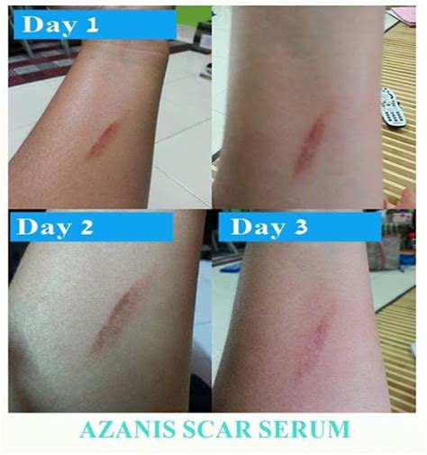 Testimoni Azanis Scar Serum Parut Di Lengan