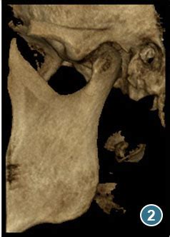 Tac de ATM Articulación Temporomandibular CBCT Radiología Dental