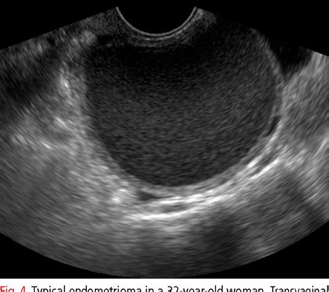 Figure 2 From Ultrasonography Of Ovarian Masses Using A Pattern