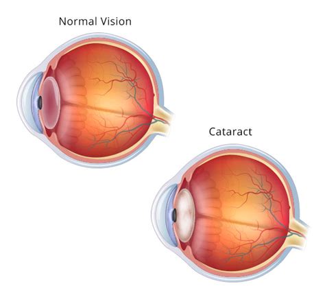 Contact Lens For Presbyopia Astigmatism And Cataracts What You Should