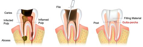 The Complete Guide To Dental Gutta Percha Its Use In Endodontics