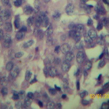 Tumor Cells With Round To Oval Nuclei With Uniform Chromatin And