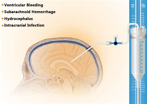 External Ventricular Drainage System Branden Medical Devices