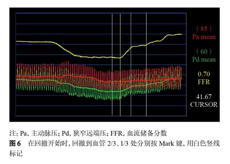 【专家共识】中国冠状动脉血流储备分数测定技术临床路径专家共识病变