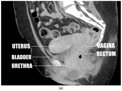 Diagnostics Free Full Text Alignment Of The Cervix With The Vagina