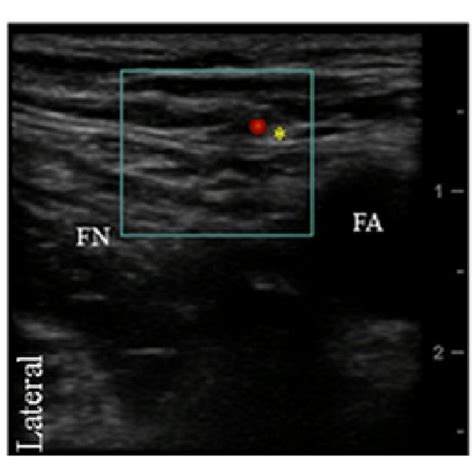 Transverse Ultrasound Image Of The Posterior Femoral Cutaneous Nerve Download Scientific