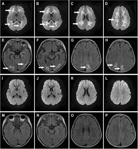 Brain Magnetic Resonance Imaging Mri A D Dwi Showed Symmetric Areas