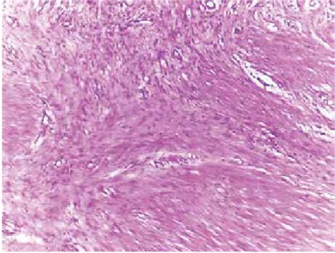 Spindle Cells Growing In Fascicles With Eosinophilic Cytoplasm And