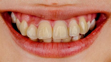 How To Prevent Treat Tooth Discoloration