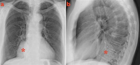 Pulmonary Sequestration What The Radiologist Should Know Clinical