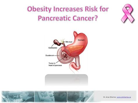 Ppt Obesity Increases Risk For Pancreatic Cancer Powerpoint