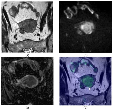 Cancers Free Full Text Staging Of Endometrial Cancer Using Fusion