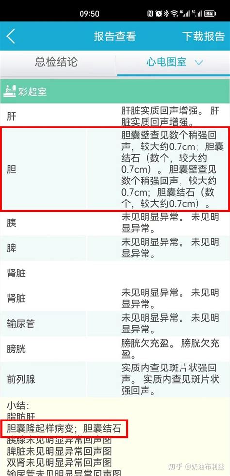 胆结石从发现到手术的全过程记录 知乎