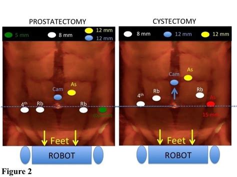 Port Placement Comparison For Robotic Radical Cystectomy As Assistant