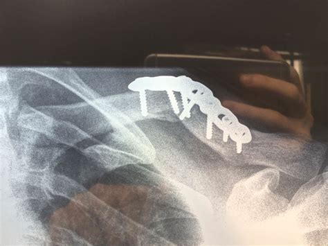 Corrective lengthening left clavicle. Three months in feel pretty bad