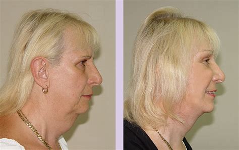 Dr Chettawut Sex Reassignment And Facial Feminization Surgery Center