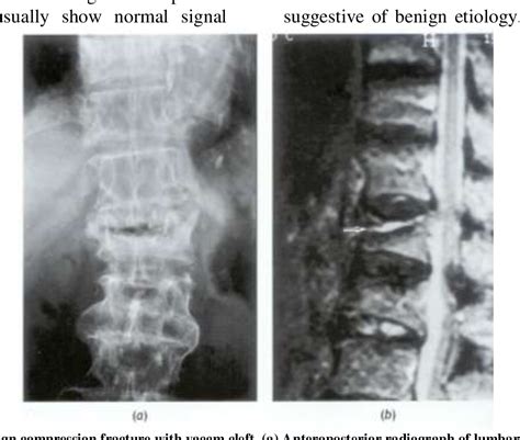 [pdf] Review Of Malignant And Benign Findings Of Compression Vertebral Fractures On Mri