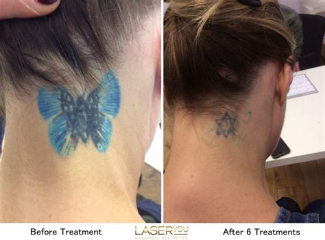 Laser Tattoo Removal Using Picosure Laseryou Picosure Tattoo Removal