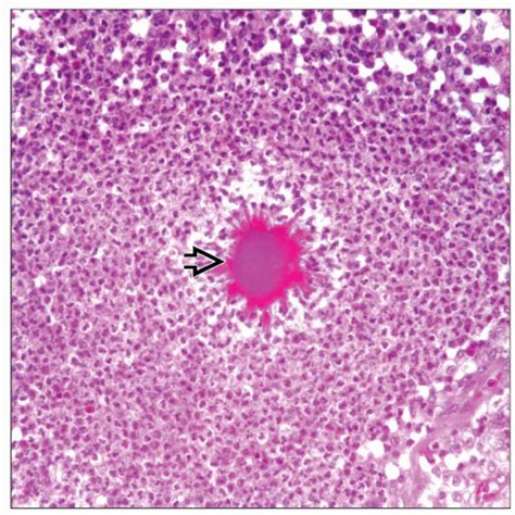 Actinomycosis Histology