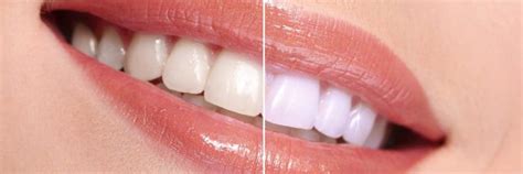 Teeth Whitening Eagle Rock Dental Care